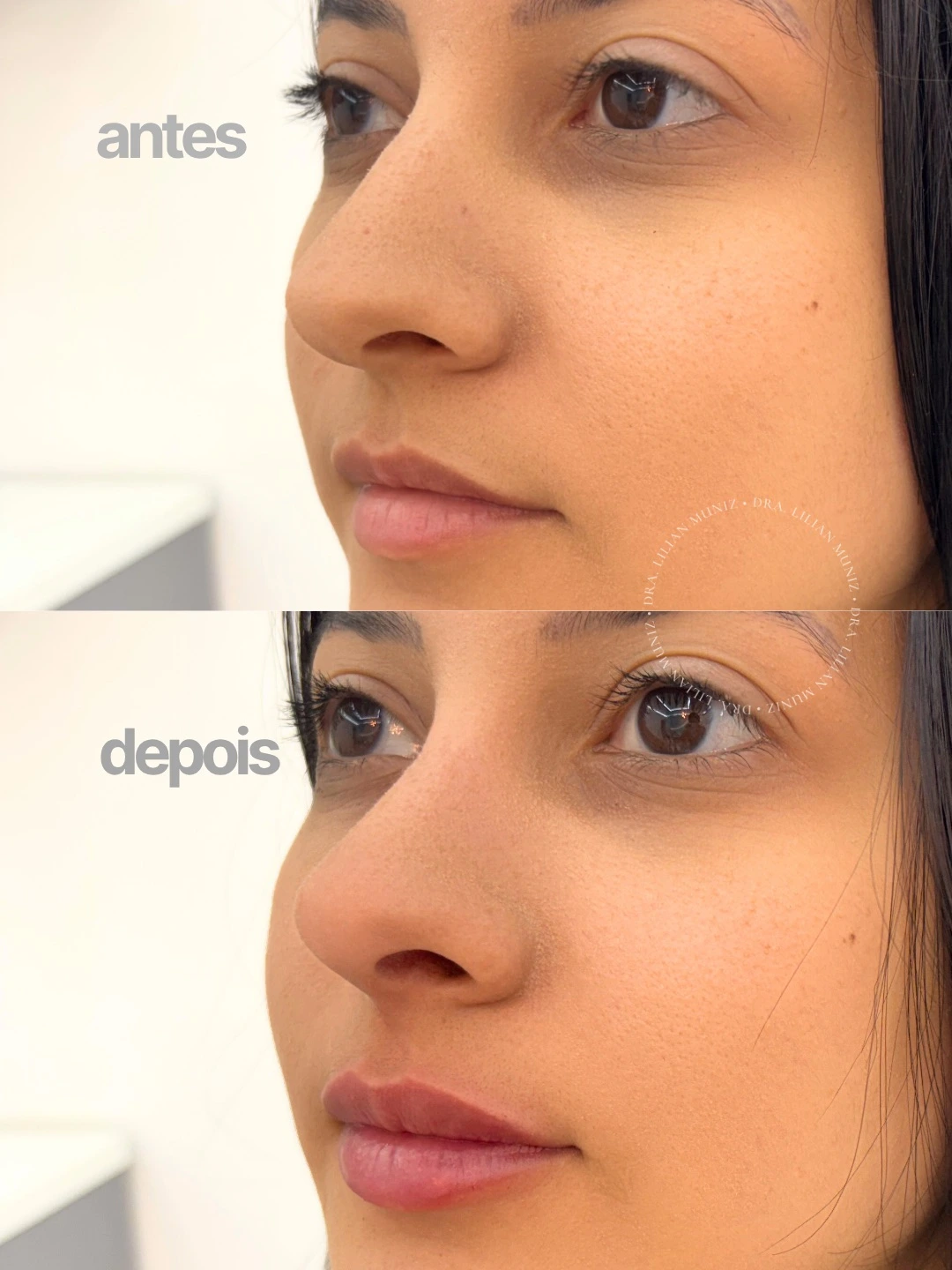 Comparação de antes e depois de preenchimento labial, caso 3 fornecido pela Dra. Lilian