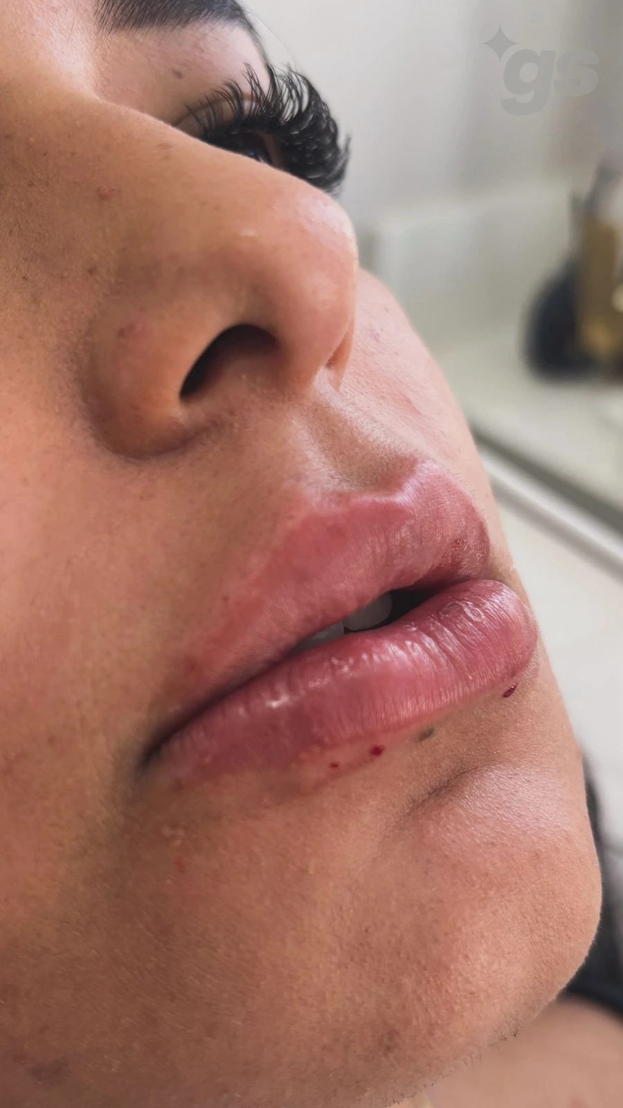Registro de resultado de preenchimento labial, caso 6 fornecido pela Dra. Lilian