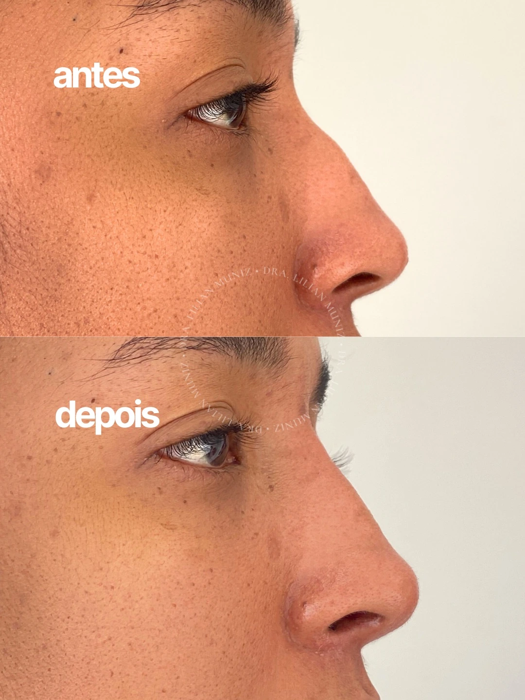 Registro comparativo de antes e depois de rinomodelação, caso 3, fornecido pela Dra. Lilian Muniz